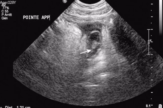 ¿Cuál es la relación entre apendicitis y fecalitos en la luz apendicular?