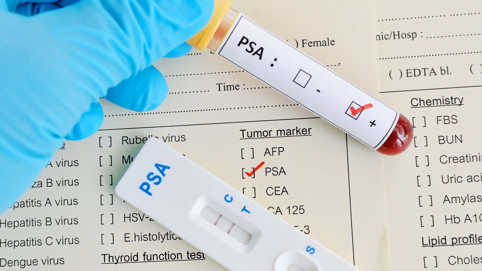 ¿Qué factores influyen en el resultado de un examen de PSA?