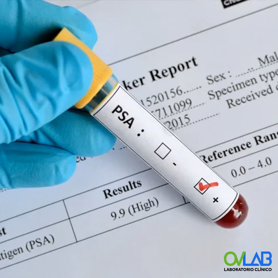 ¿Cuándo preocuparse por el PSA libre?